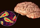 Kerala Confirms 67 Cases and 18 Deaths from Brain-Eating Amoeba in 2025